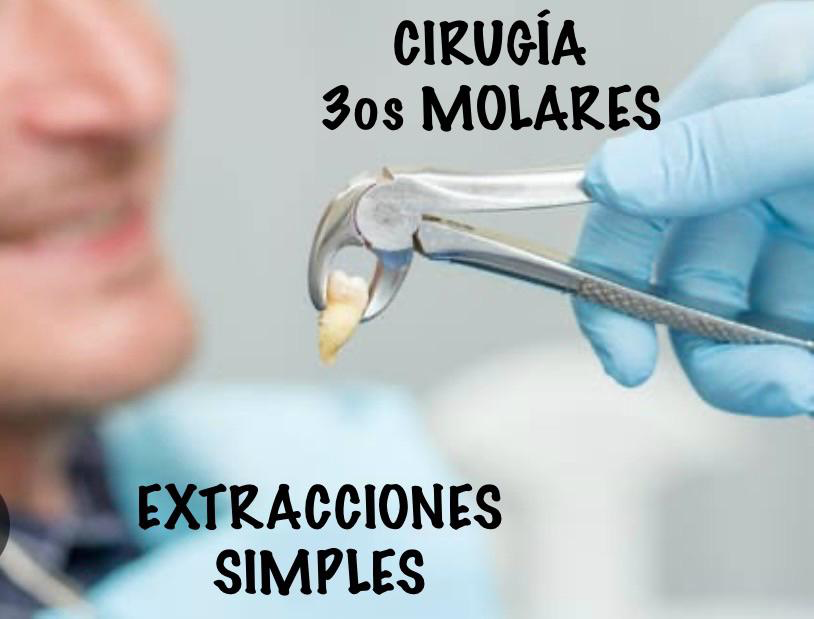 Servicio de extracciones simples